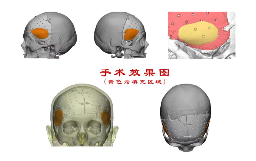 林志穎車禍致顏面骨折，醫(yī)生：或可用3D打印建模進行術后修復