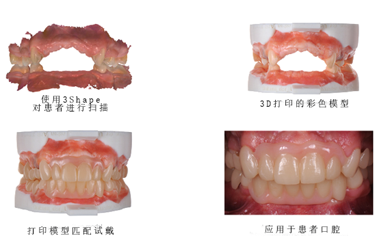 3Shape彩色工作流程，讓牙齒假體越來(lái)越“真”！